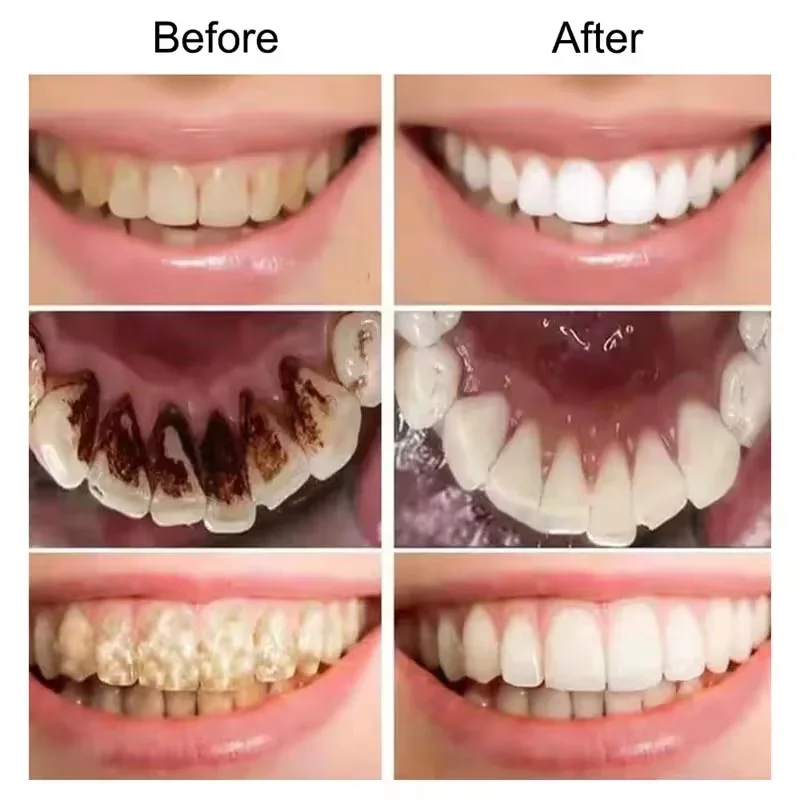 Teeth Whitening Toothpaste Rem - Teeth Whitening Opalescence ulasan dan harga