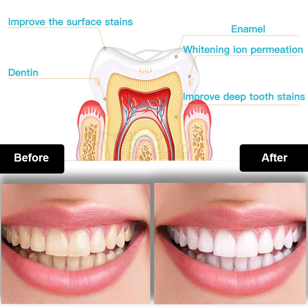 Dental Teeth Whitening Kit Min - Teeth Whitening At Home ulasan dan harga